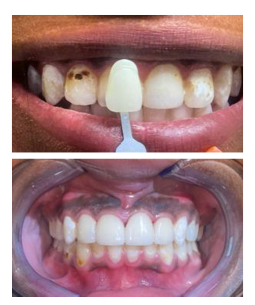 Veneers before and after