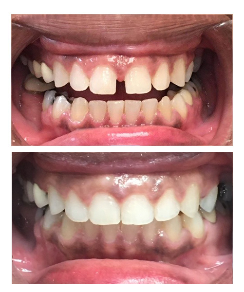 Invisalign before and after