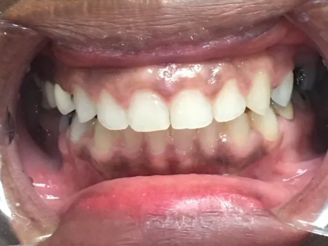 After dental treatment at Artistic Dental Centre