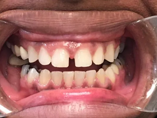 Before dental treatment at Artistic Dental Centre