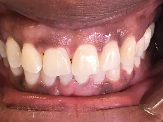 After cosmetic dental treatment at Artistic Dental Centre