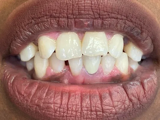 Before cosmetic dental treatment at Artistic Dental Centre